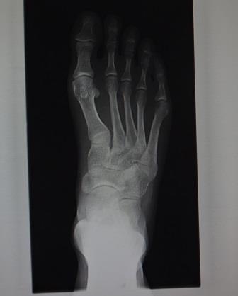 DSC03379足x-ray